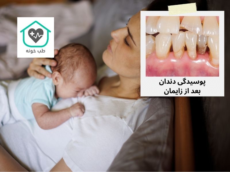 پوسیدگی دندان بعد از زایمان