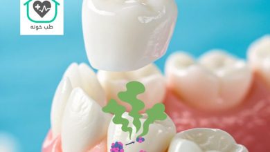 آیا دندان روکش شده خراب می‌شود