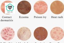 انواع حساسیت های پوستی با عکس