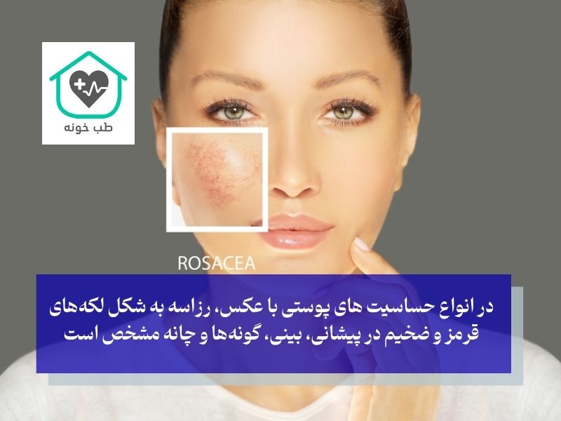 انواع حساسیت های پوستی با عکس رزاسه