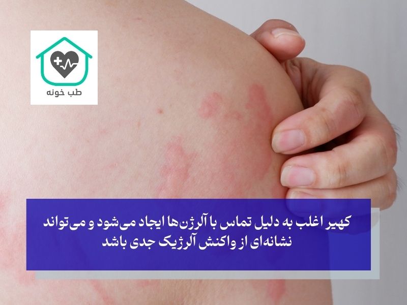 انواع حساسیت های پوستی با عکس کهیر