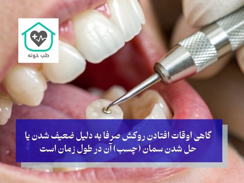 اگر روکش من بیفتد، آیا همیشه به معنی خراب شدن دندان زیر آن است