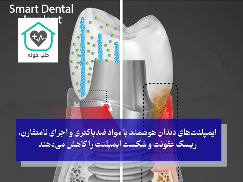 ایمپلنت‌های هوشمند مجهز به حسگر