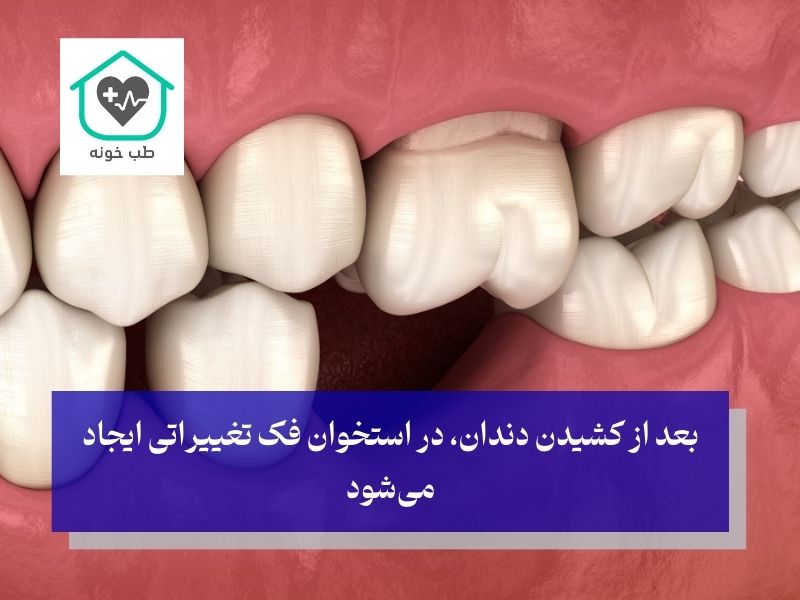 تغییرات استخوان فک بعد از کشیدن دندان