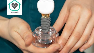 جدیدترین روش ایمپلنت