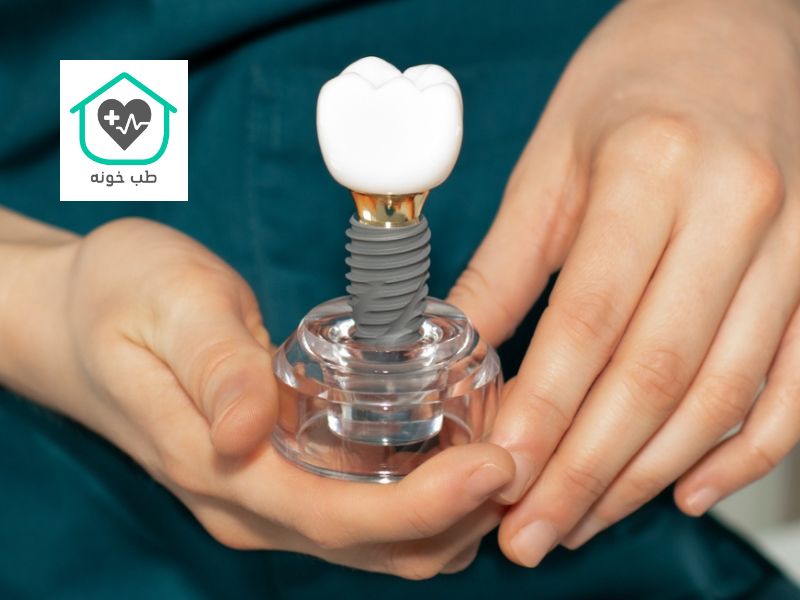 جدیدترین روش ایمپلنت