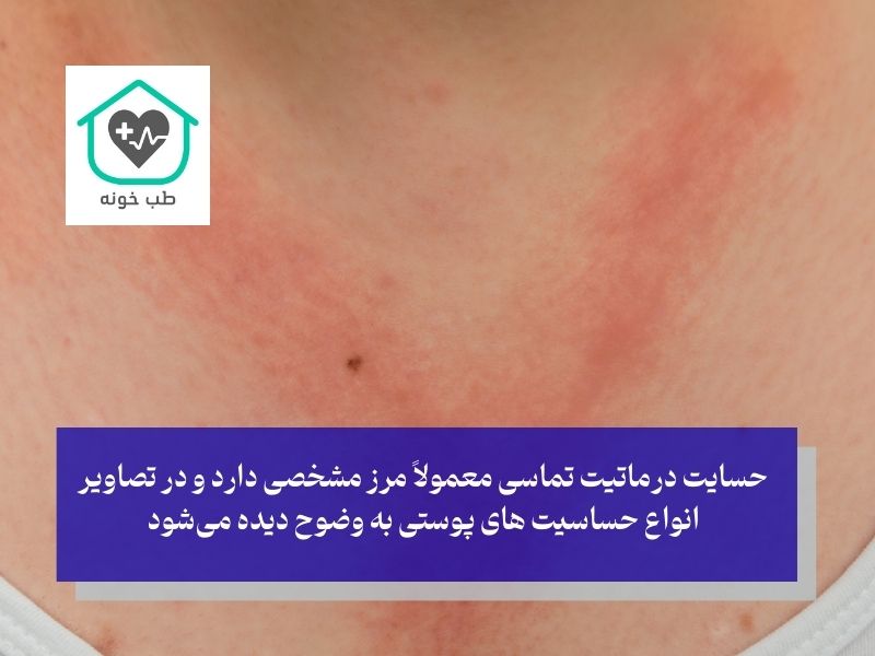 حساسیت پوستی ناشی از تماس مستقیم