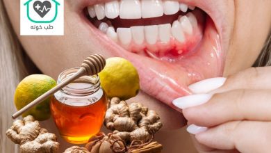 درمان خانگی آفت دهان