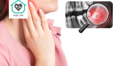 عفونت دندان عقل