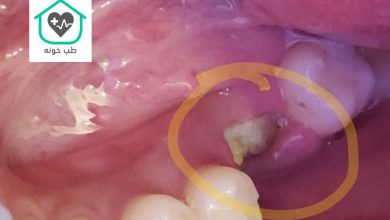 علت سفید شدن لثه بعد از کشیدن دندان