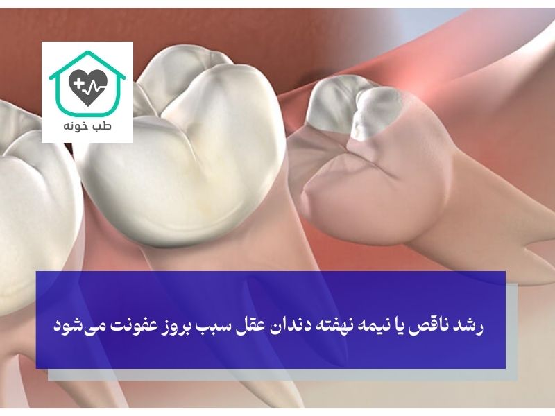 علل بروز عفونت دندان عقل