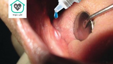 قطره برای زخم لثه دندان مصنوعی