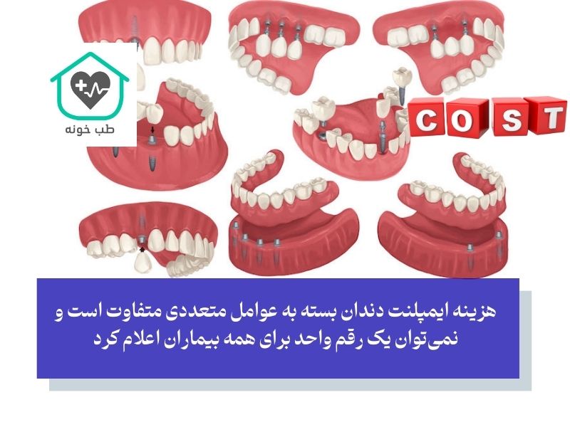 قیمت ایمپلنت به روش‌های مختلف