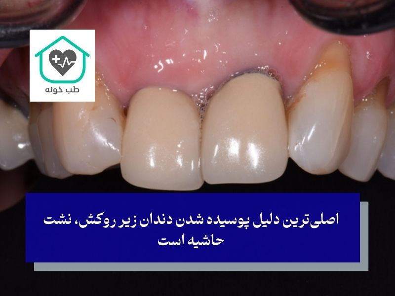 مقصران اصلی خرابی روکش