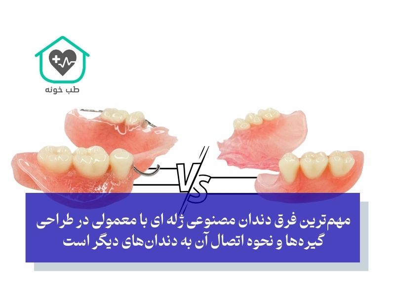 مهم‌ترین فرق دندان مصنوعی ژله ای با معمولی