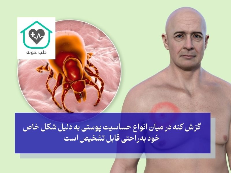 گزش کنه از انواع دانه های حساسیت پوستی