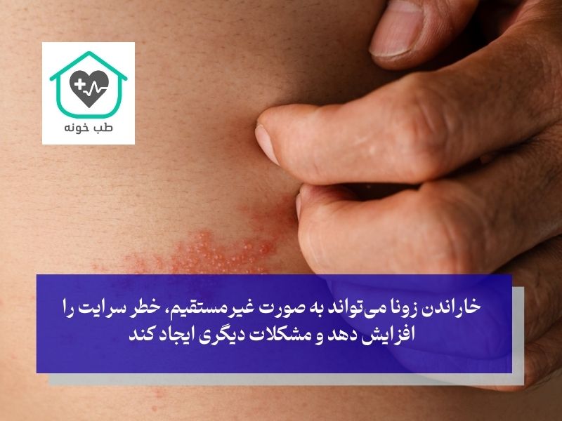 آیا زونا از طریق خاراندن منتقل می‌شود