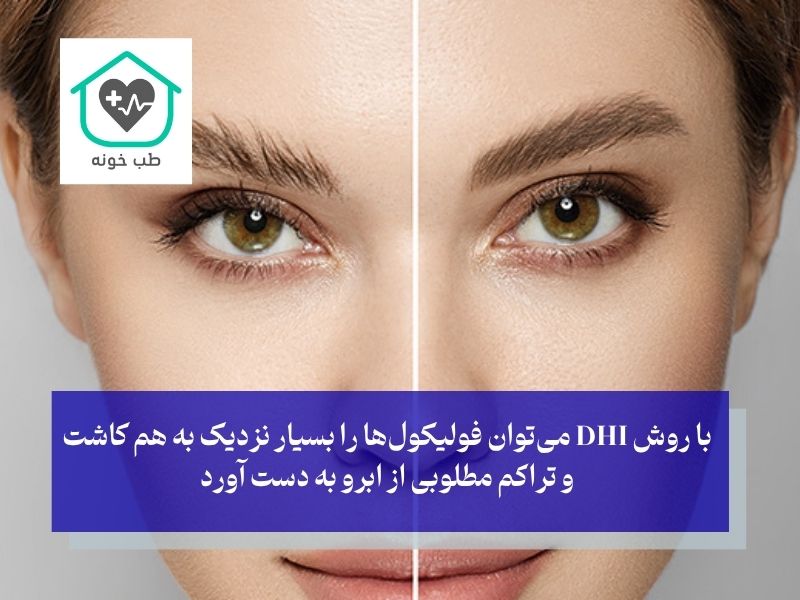 بهترین روش در بهترین کلینیک کاشت ابرو در تهران