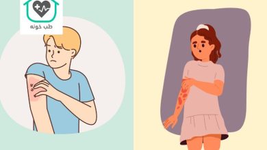 بیماری زونا واگیردار است