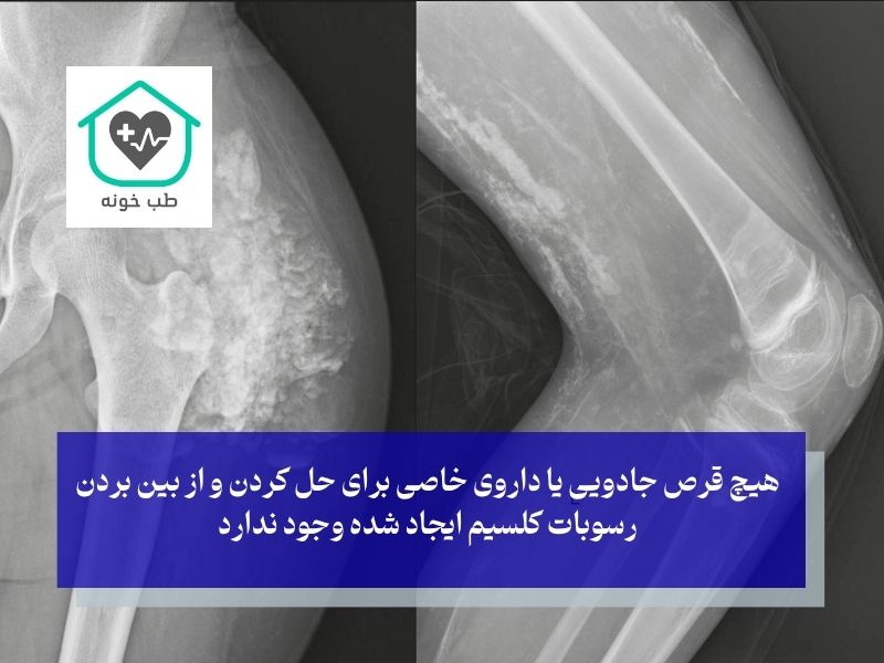 تشخیص و درمان کلسیفیکاسیون