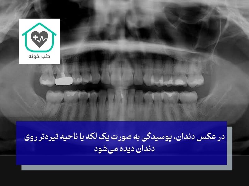تفسیر عکس دندان؛ دندانپزشک در عکس دندان خراب چه می‌بیند