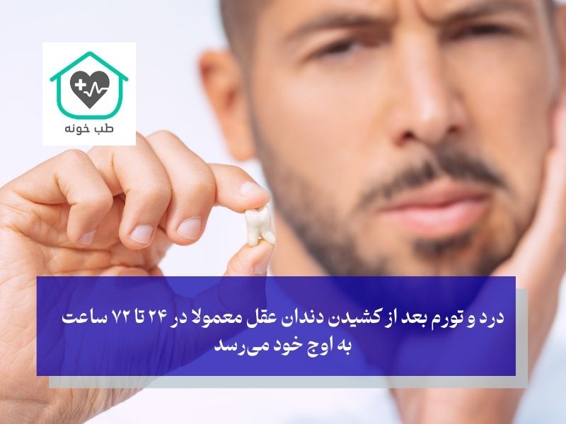 درد بعد از کشیدن دندان عقل؛ این درد چند روز طول میکش