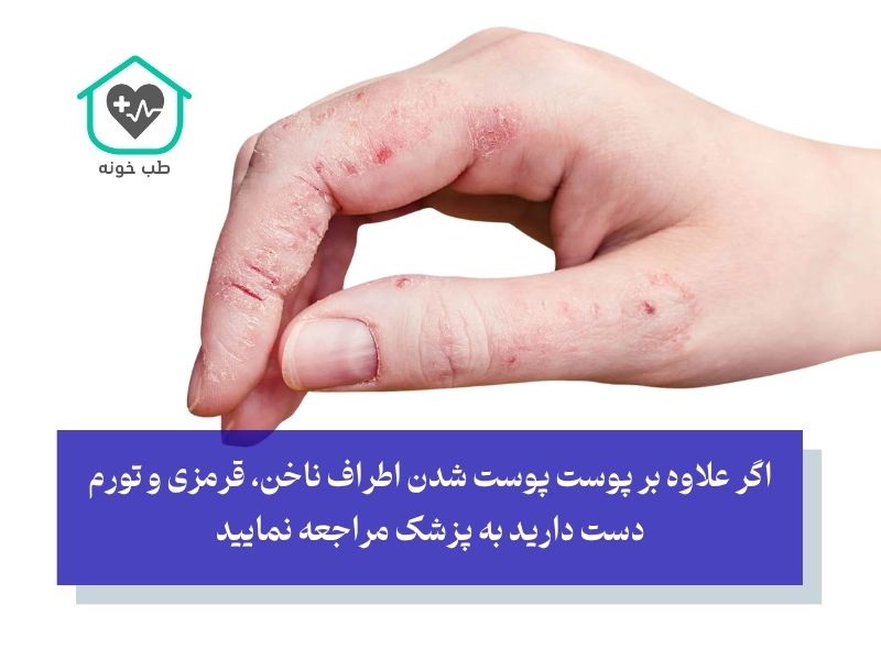 علائم مهم درباره پوسته شدن اطراف ناخن