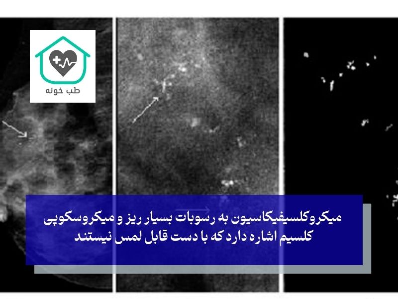 میکروکلسیفیکاسیون چیست؟