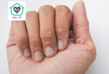 پوست پوست شدن دور ناخن