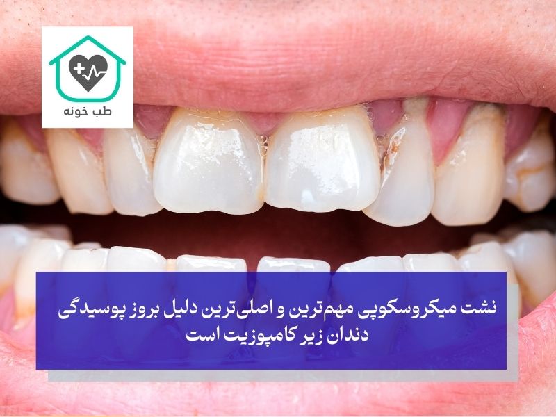 پوسیدگی دندان زیر کامپوزیت چگونه و چرا رخ می‌دهد