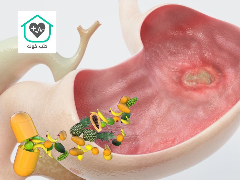 چه میوه هایی برای زخم معده مفید است