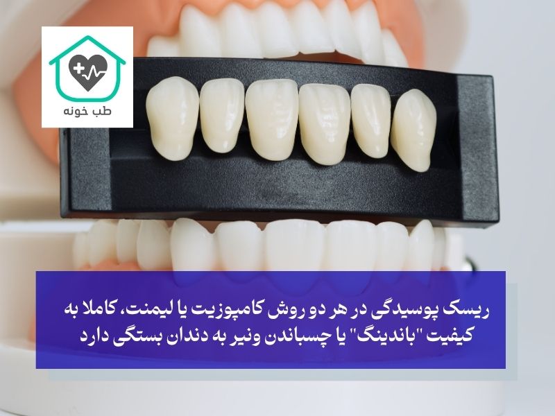 کامپوزیت در برابر لمینت؛ کدام یک ریسک پوسیدگی کمتری دارد