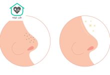 از بین بردن جوش سر سیاه بینی