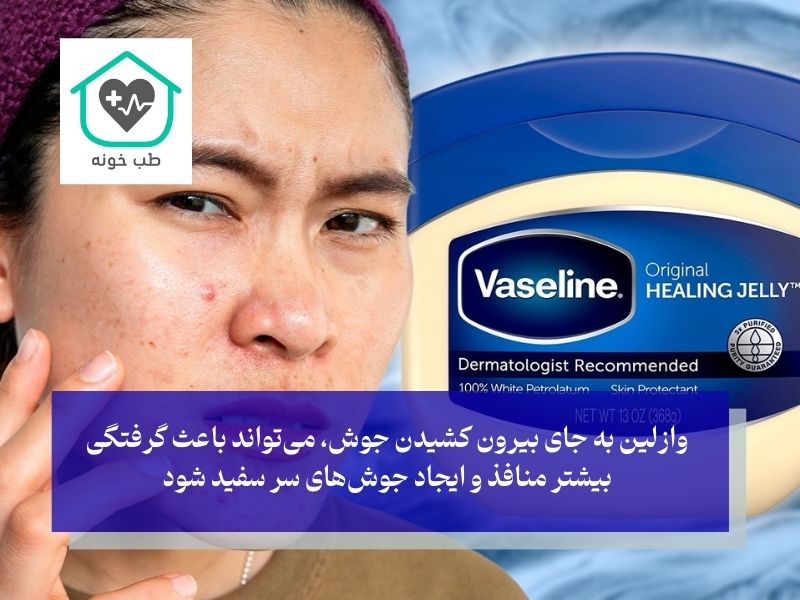 از بین بردن جوش سر سیاه بینی با وازلین