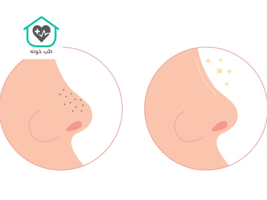 از بین بردن جوش سر سیاه بینی