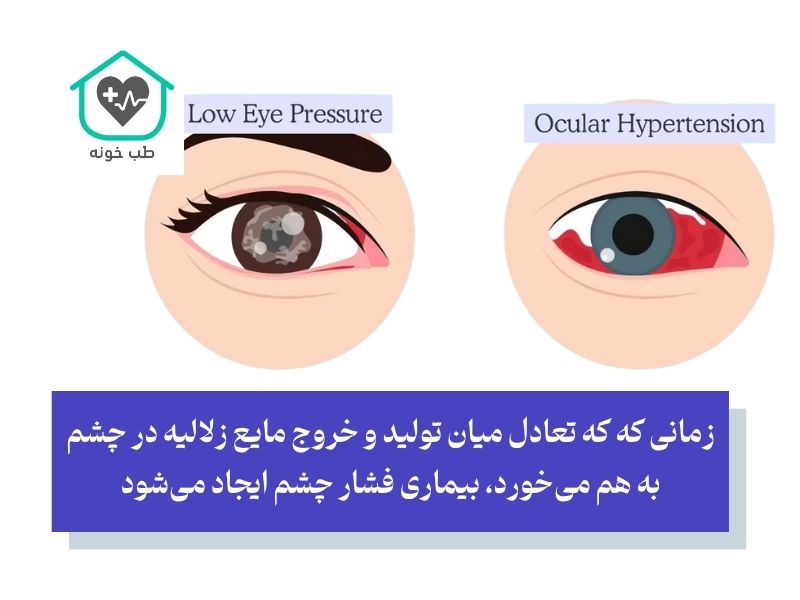 اهمیت دانستن چه غذاهایی فشار چشم را بالا میبرد