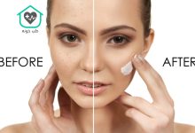 بهترین کرم ضد لک بدون بازگشت