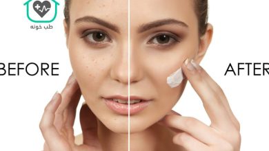 بهترین کرم ضد لک بدون بازگشت