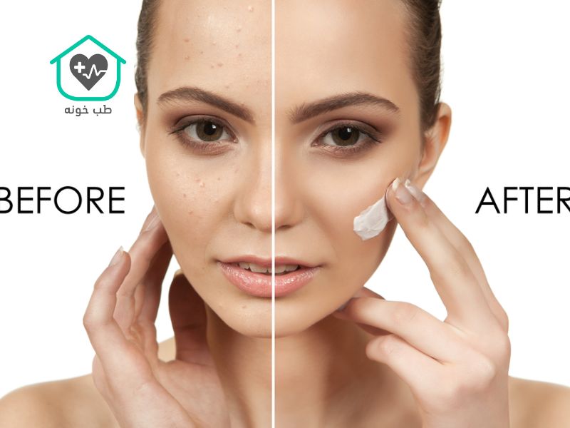 بهترین کرم ضد لک بدون بازگشت