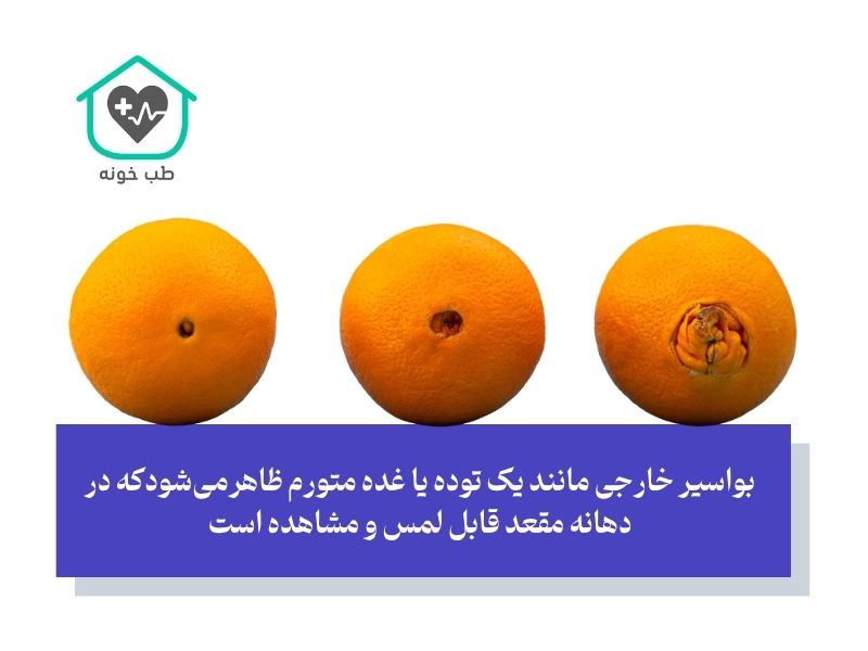 بواسیر چیست با عکس