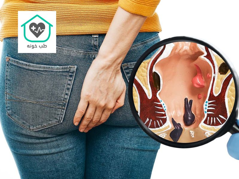 بواسیر چیست