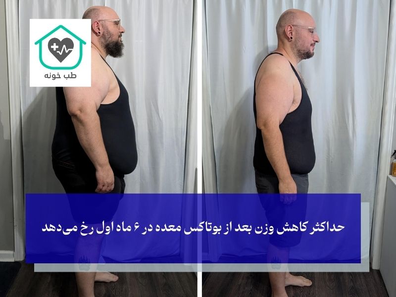 بوتاکس معده چه زمانی اثر میکند