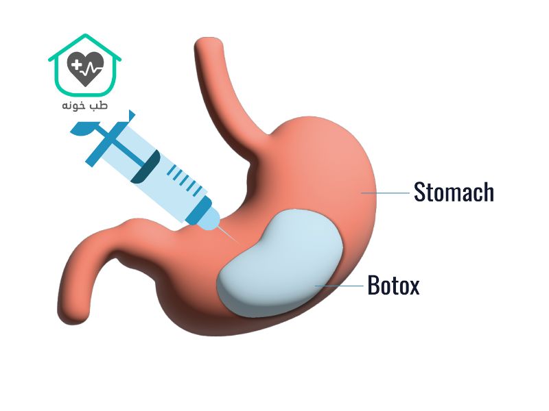 بوتاکس معده چیست