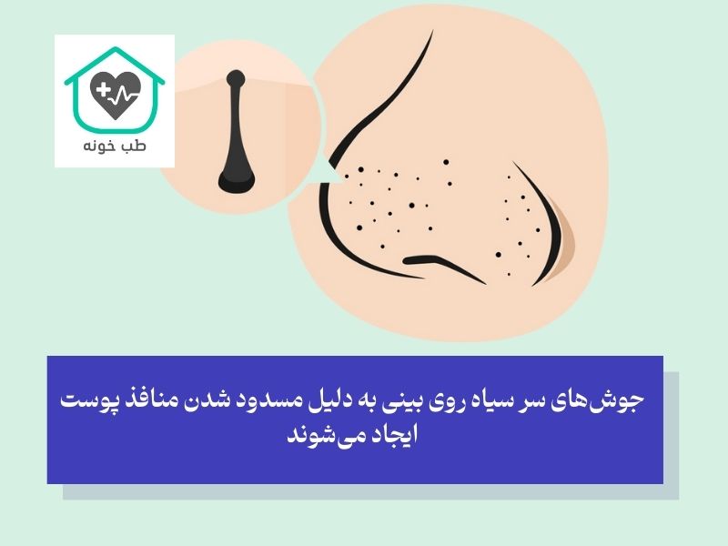 جوش سر سیاه چیست؟