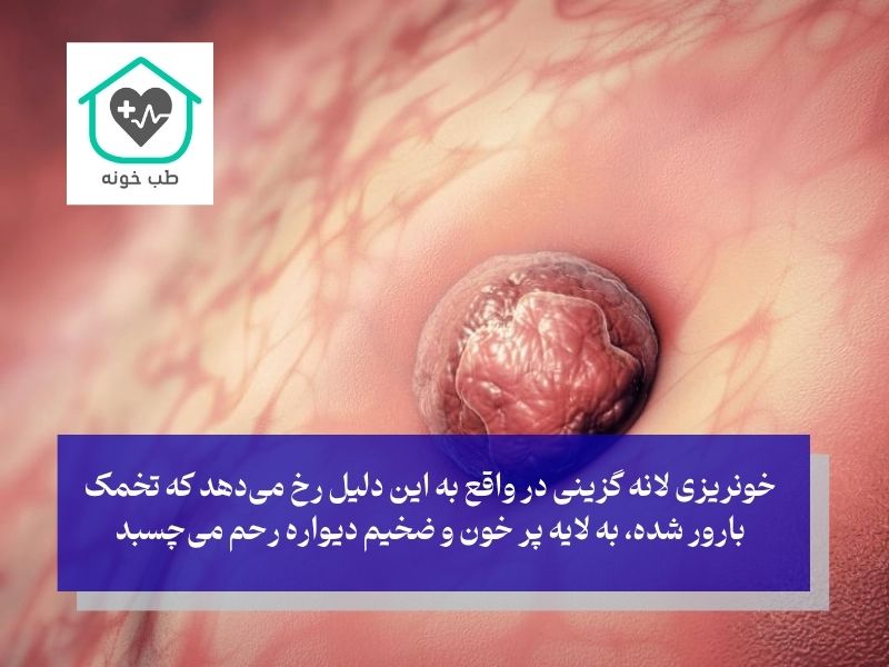 خونریزی لانه گزینی