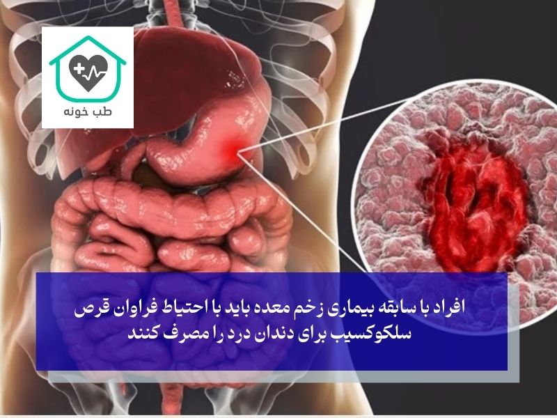 داروی سلکوکسیب برای دندان درد برای همه مناسب است؟