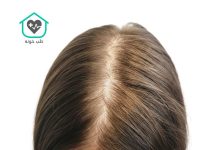 ریزش مو آندروژنیک در زنان