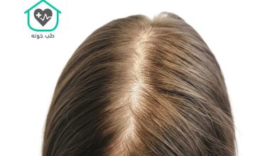 ریزش مو آندروژنیک در زنان