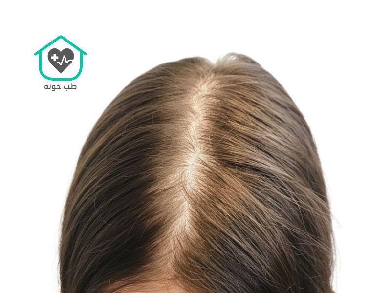 ریزش مو آندروژنیک در زنان