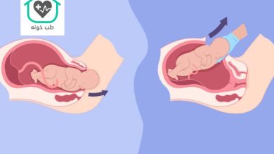 زایمان طبیعی بهتر است یا سزارین